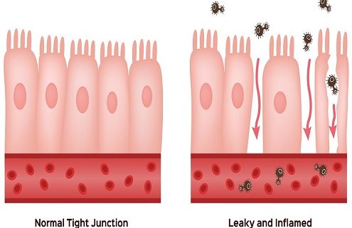 A cartoon image of normal tight junctions in gut barrier, and one that has gaps between the cells, indicating a leaky and inflamed gut. leaky and inflamed gut that have spaces between the cells.