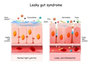 A graphical image of a normal and a leaky gut lining, with text labeling the various components below.
