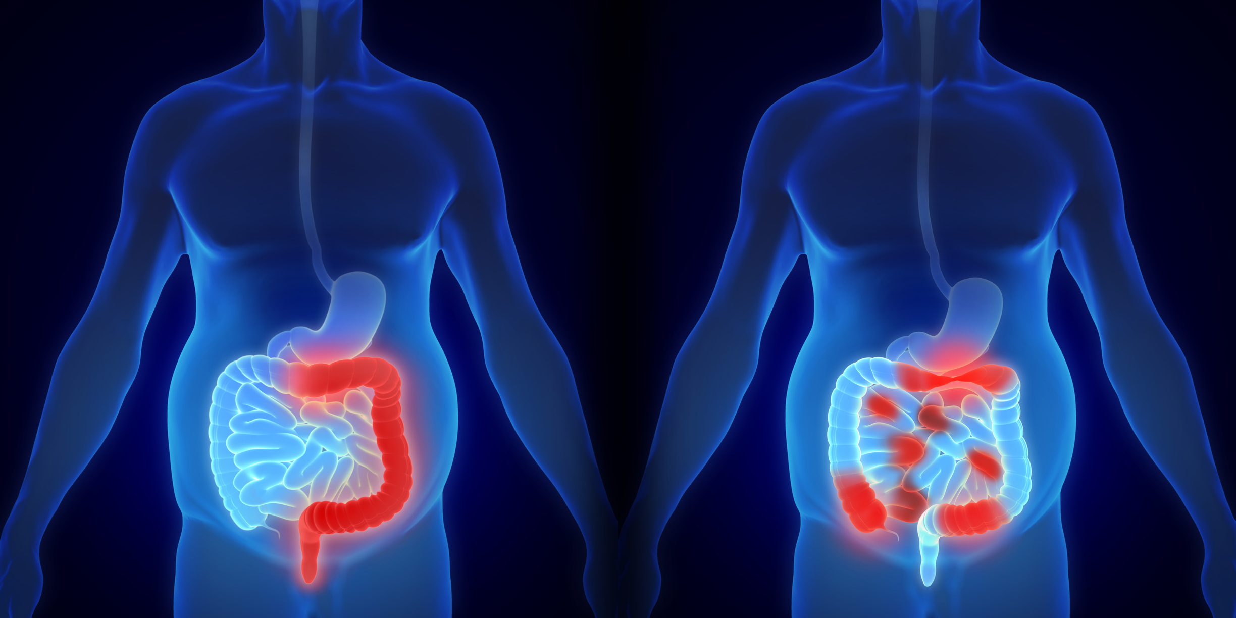 Two 3d images of a human body and intestines, one with Crohn's disease, the other with ulcerative colitis. 