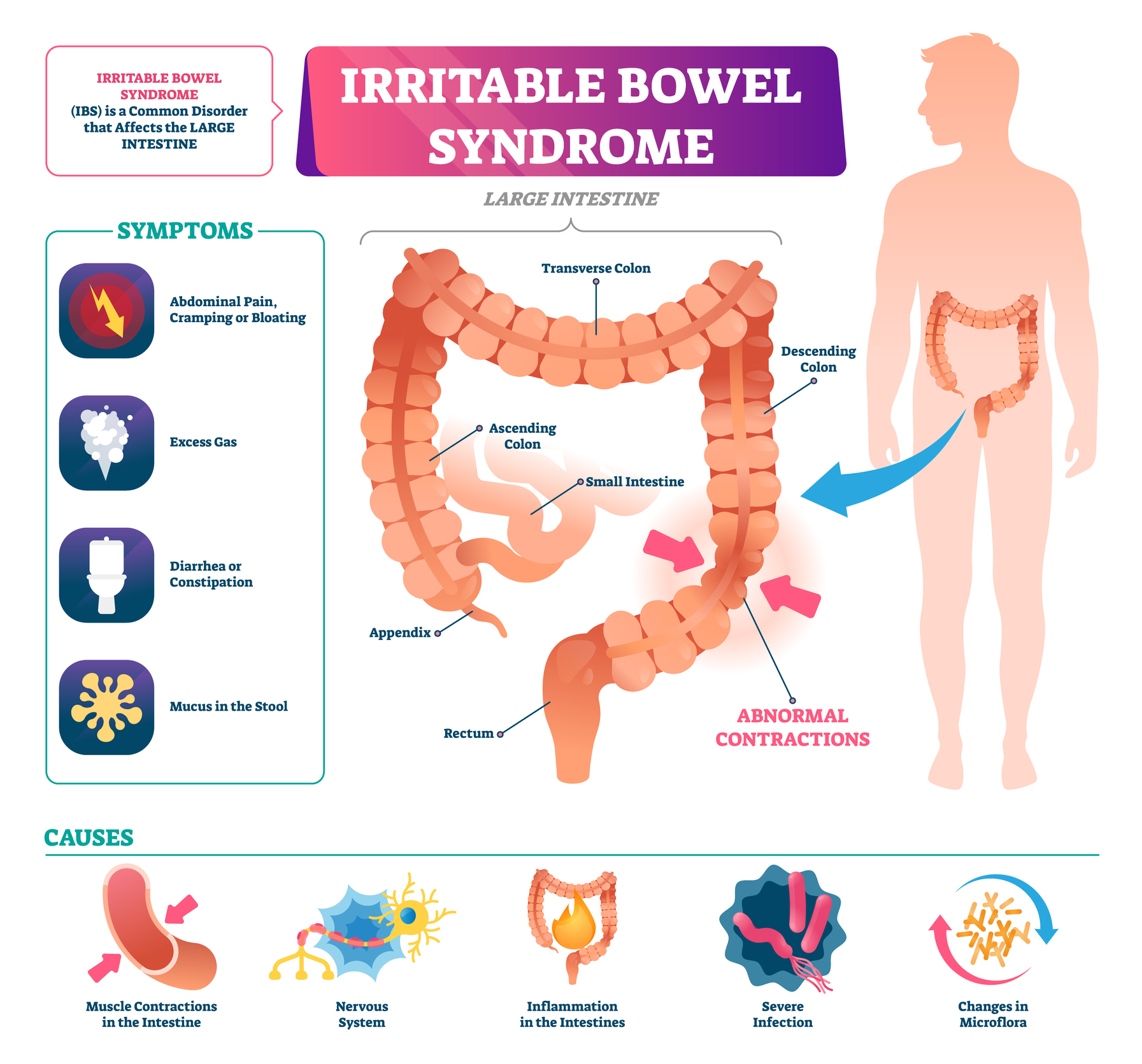 Cartoon images of a human body and large intestine and images illustrating symptoms and causes of irritable bowel syndrome with explanatory text described below. 