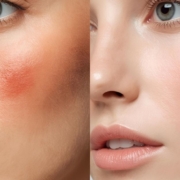 dark spot corrector